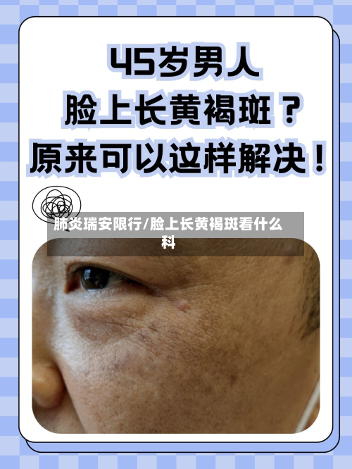 肺炎瑞安限行/脸上长黄褐斑看什么科