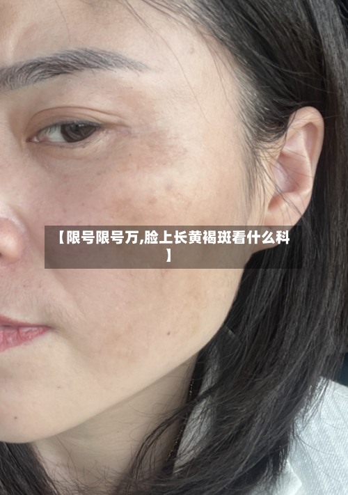 【限号限号万,脸上长黄褐斑看什么科】-第3张图片