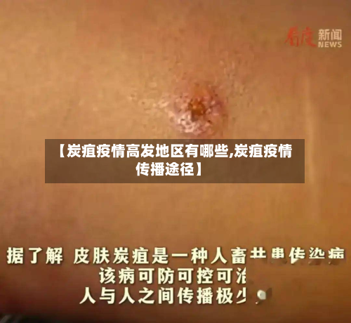 【炭疽疫情高发地区有哪些,炭疽疫情传播途径】